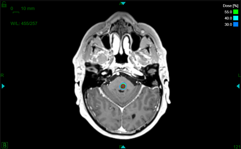 Cavernom - Swiss Neuro Radiosurgery Center